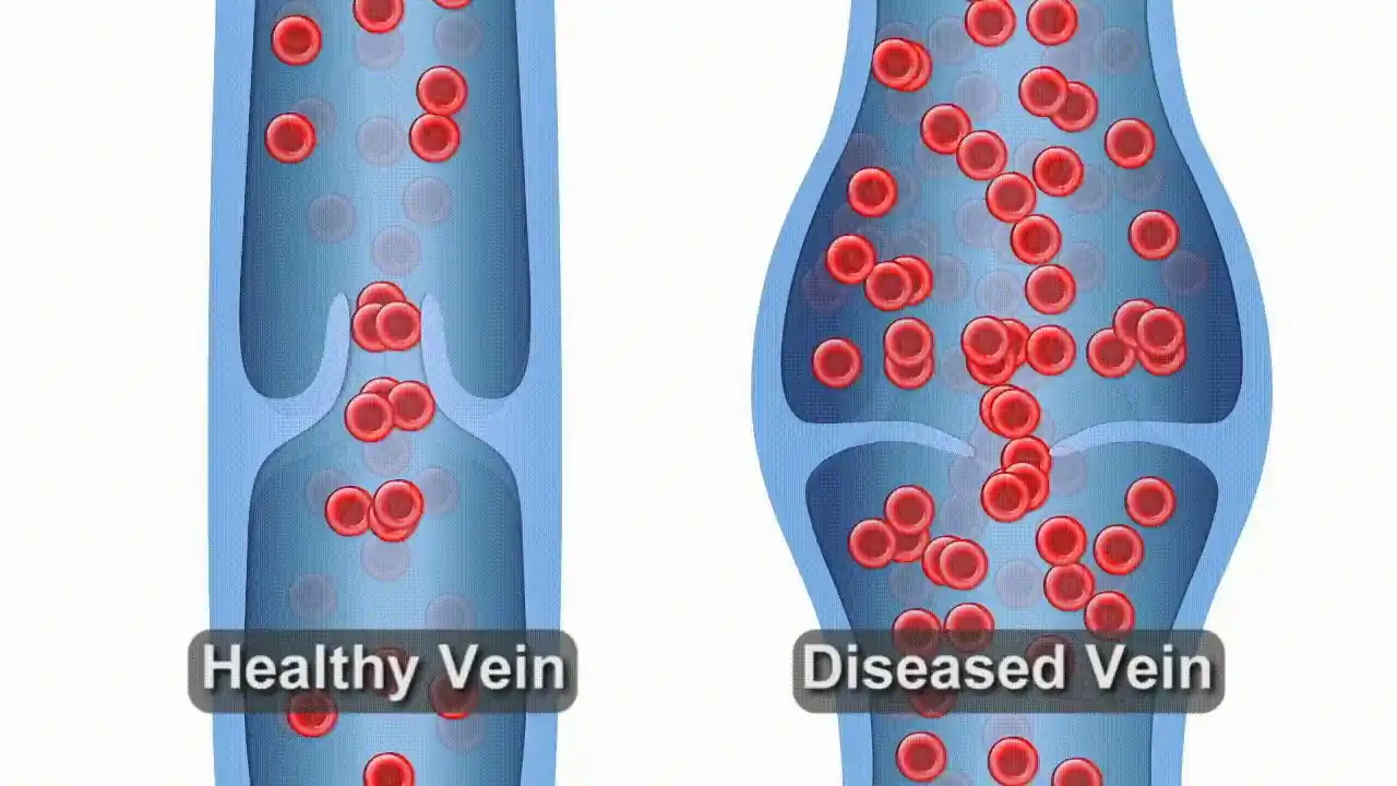 Animation showing blood refluxing backward through a failed vein valve — the mechanism behind chronic venous insufficiency.