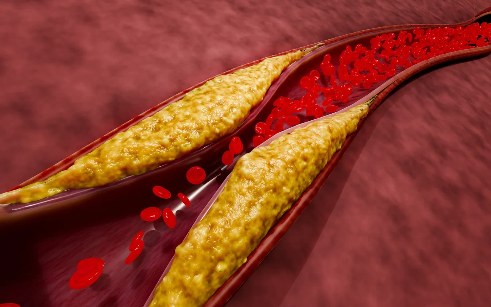 Cross-section of an artery narrowed by cholesterol plaque buildup (atherosclerosis), restricting blood flow to the legs.