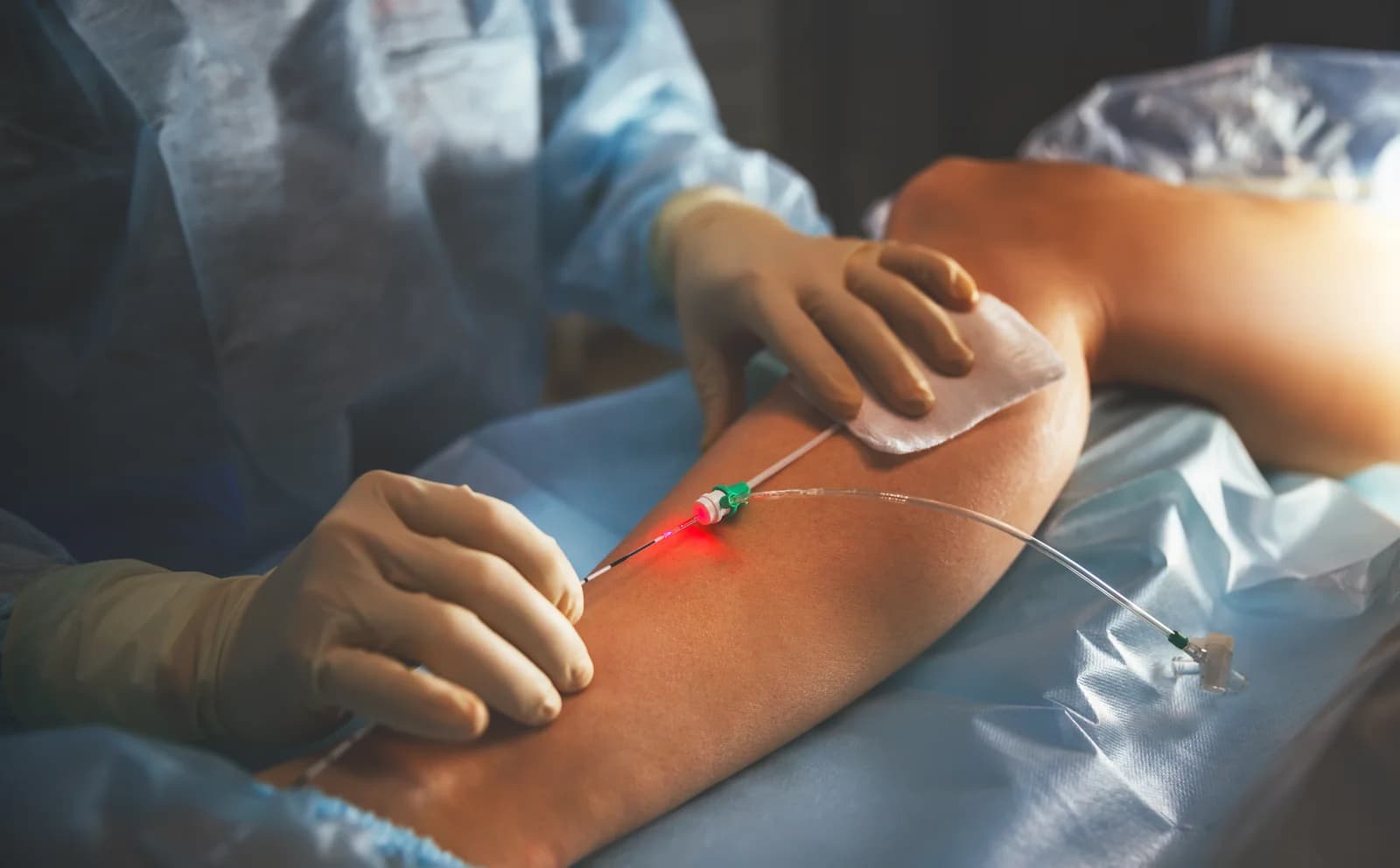Minimally invasive catheter-based angioplasty being performed on a patient's leg in the office.