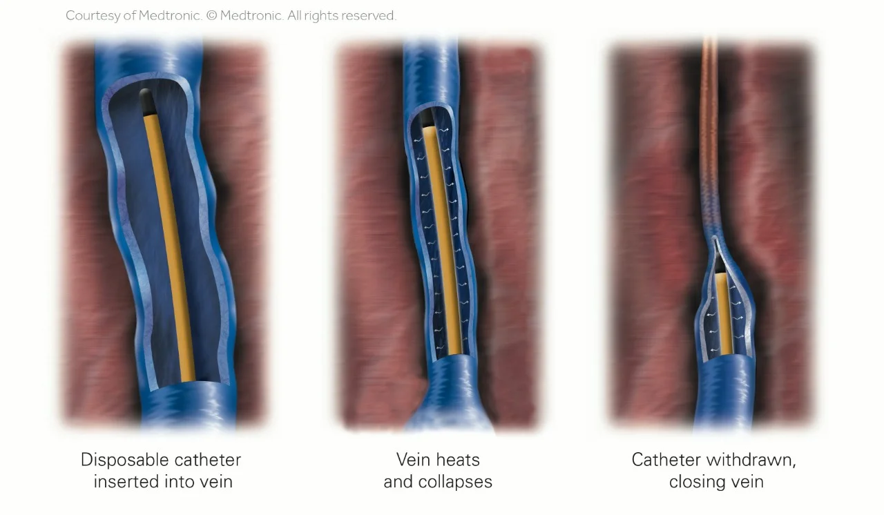 Three-stage medical illustration of the ClosureFast procedure: catheter inserted, vein heats and collapses, catheter withdrawn.