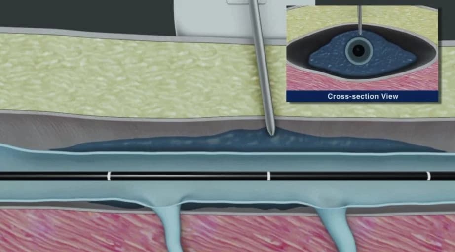 Medical illustration of tumescent anesthesia being administered around the vein during a ClosureFast procedure.