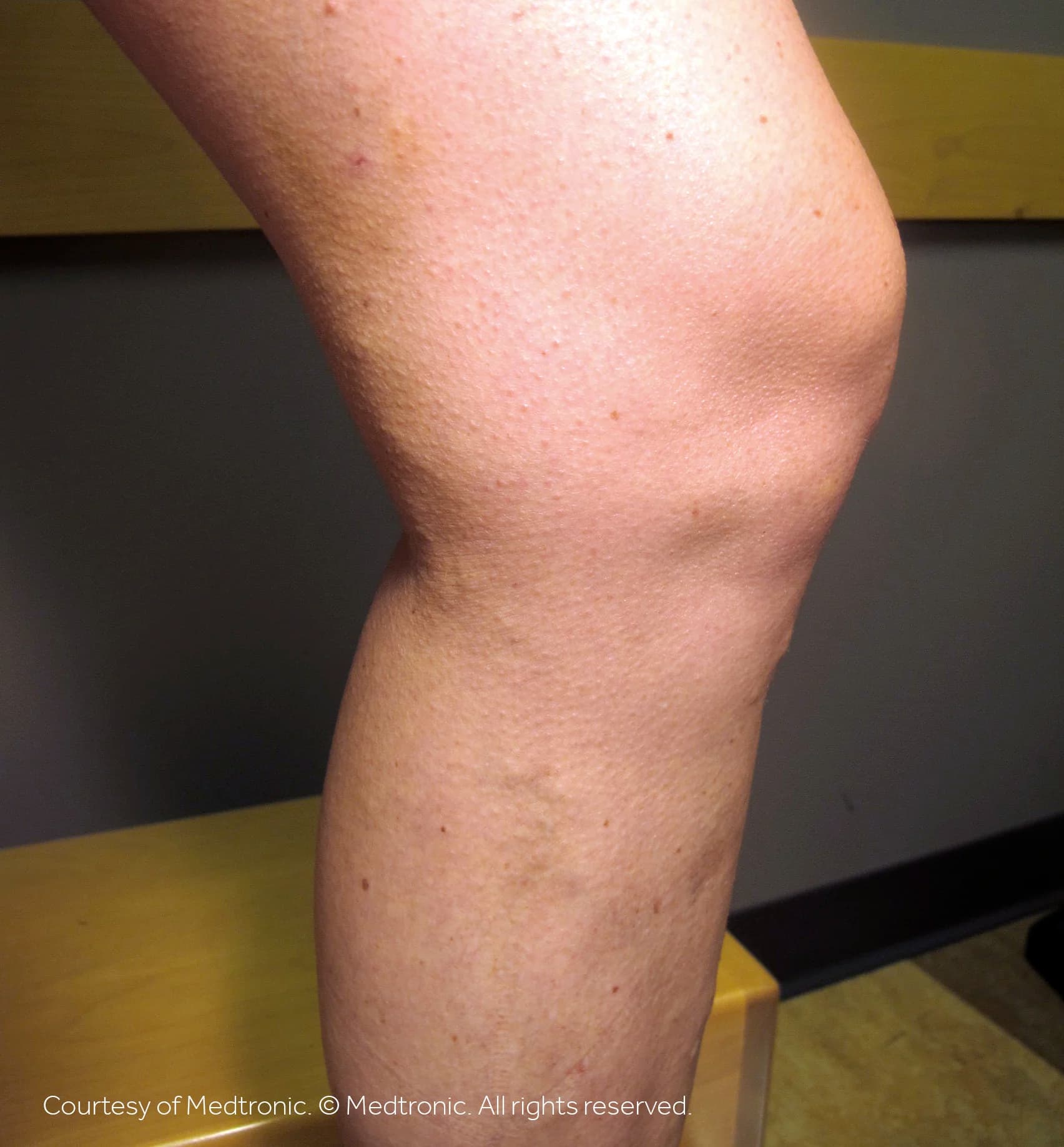 Patient 01, after vein closure procedure.