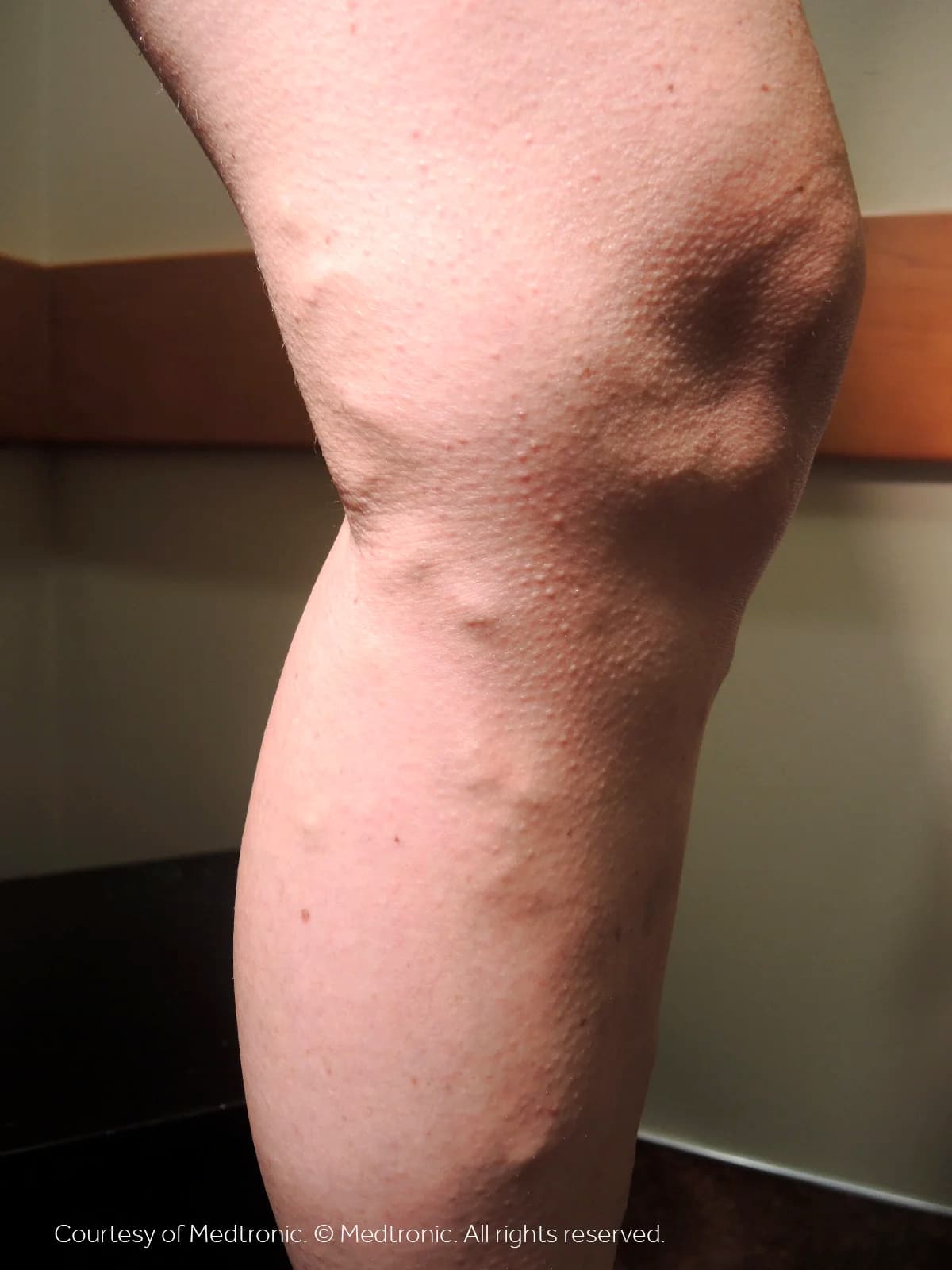 Patient 01, before vein closure procedure.