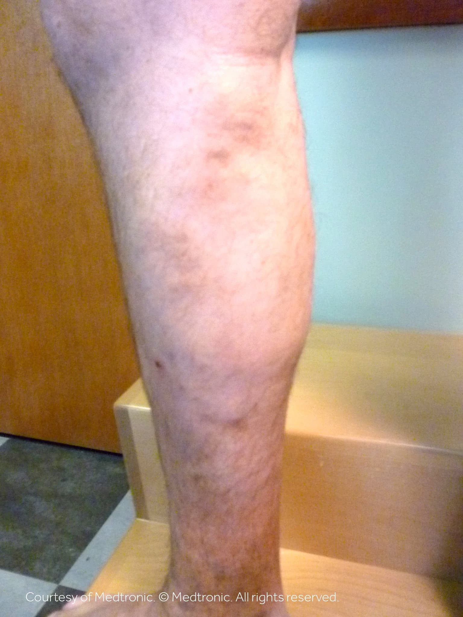 Patient 02, after vein closure procedure.