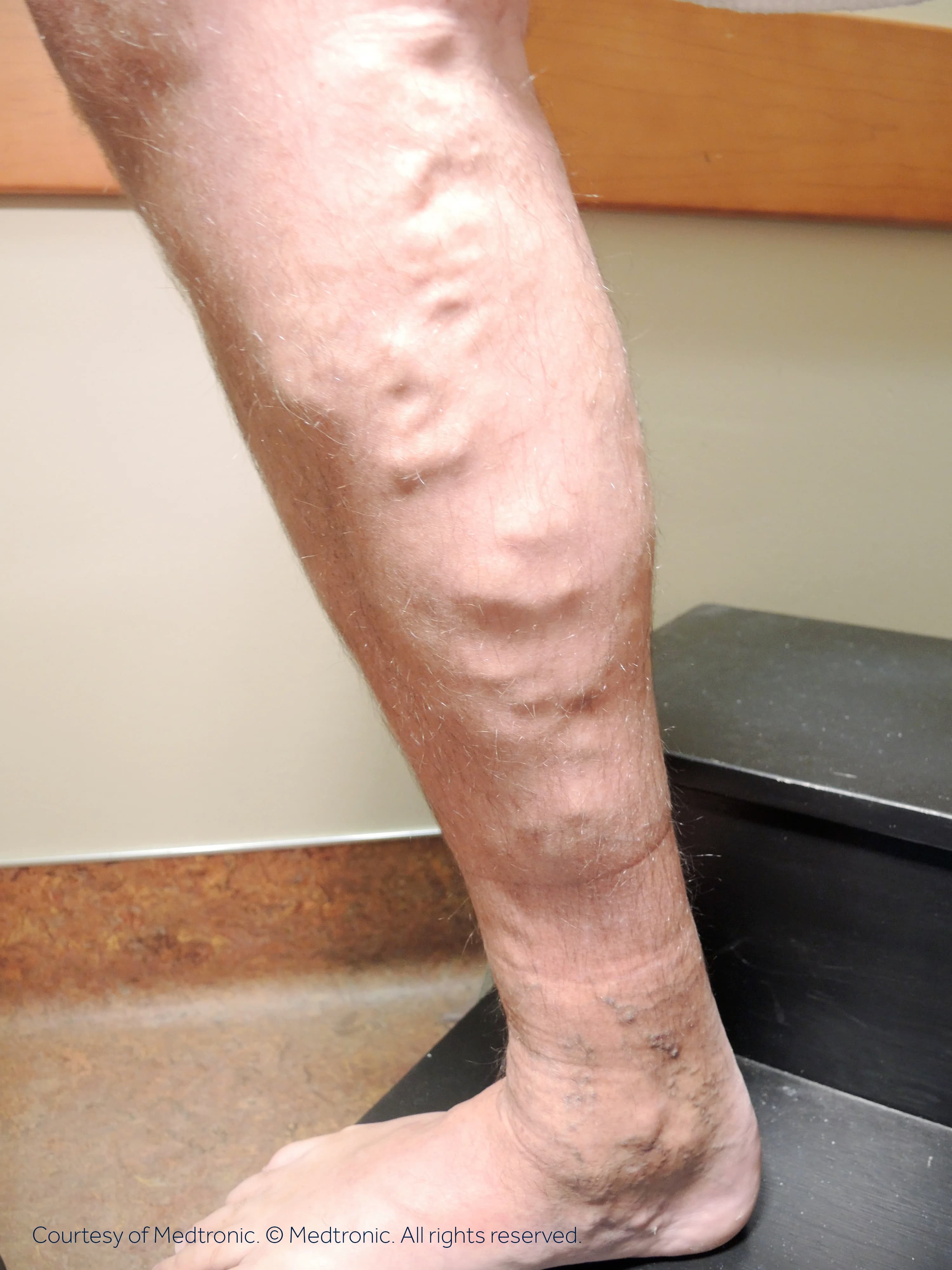 Patient 02, before vein closure procedure.