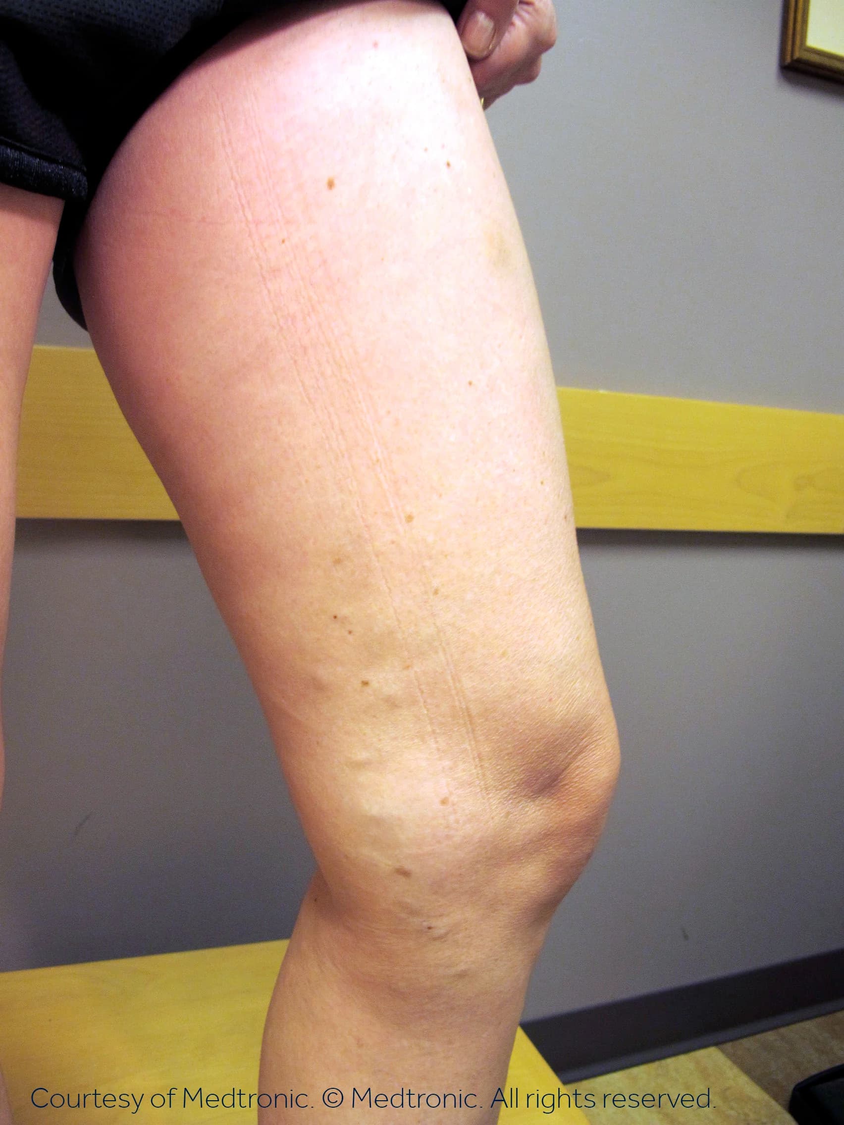 Patient 04, after vein closure procedure.