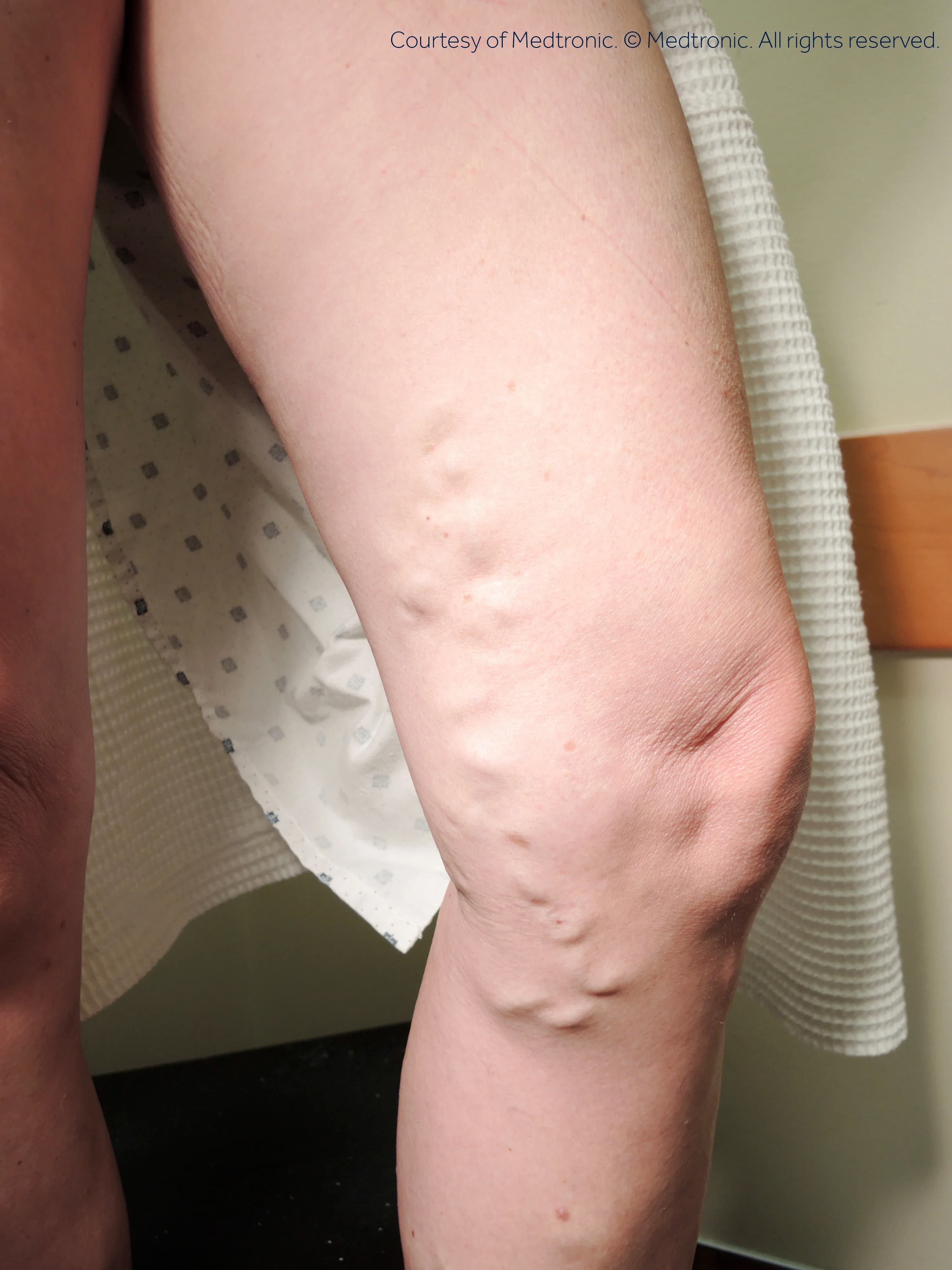 Patient 04, before vein closure procedure.
