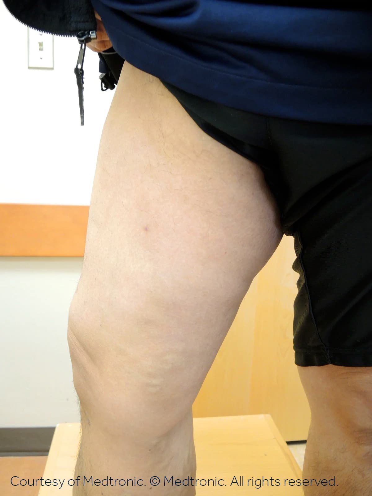 Patient 06, after vein closure procedure.