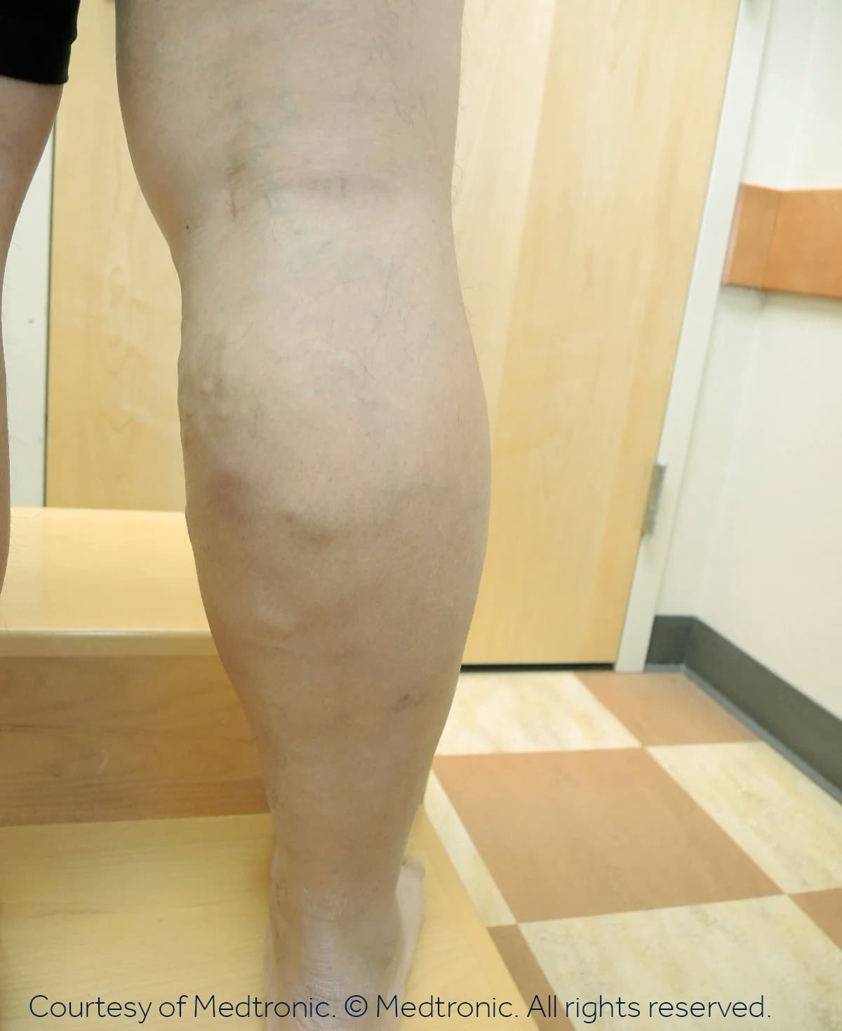 Patient 07, after vein closure procedure.