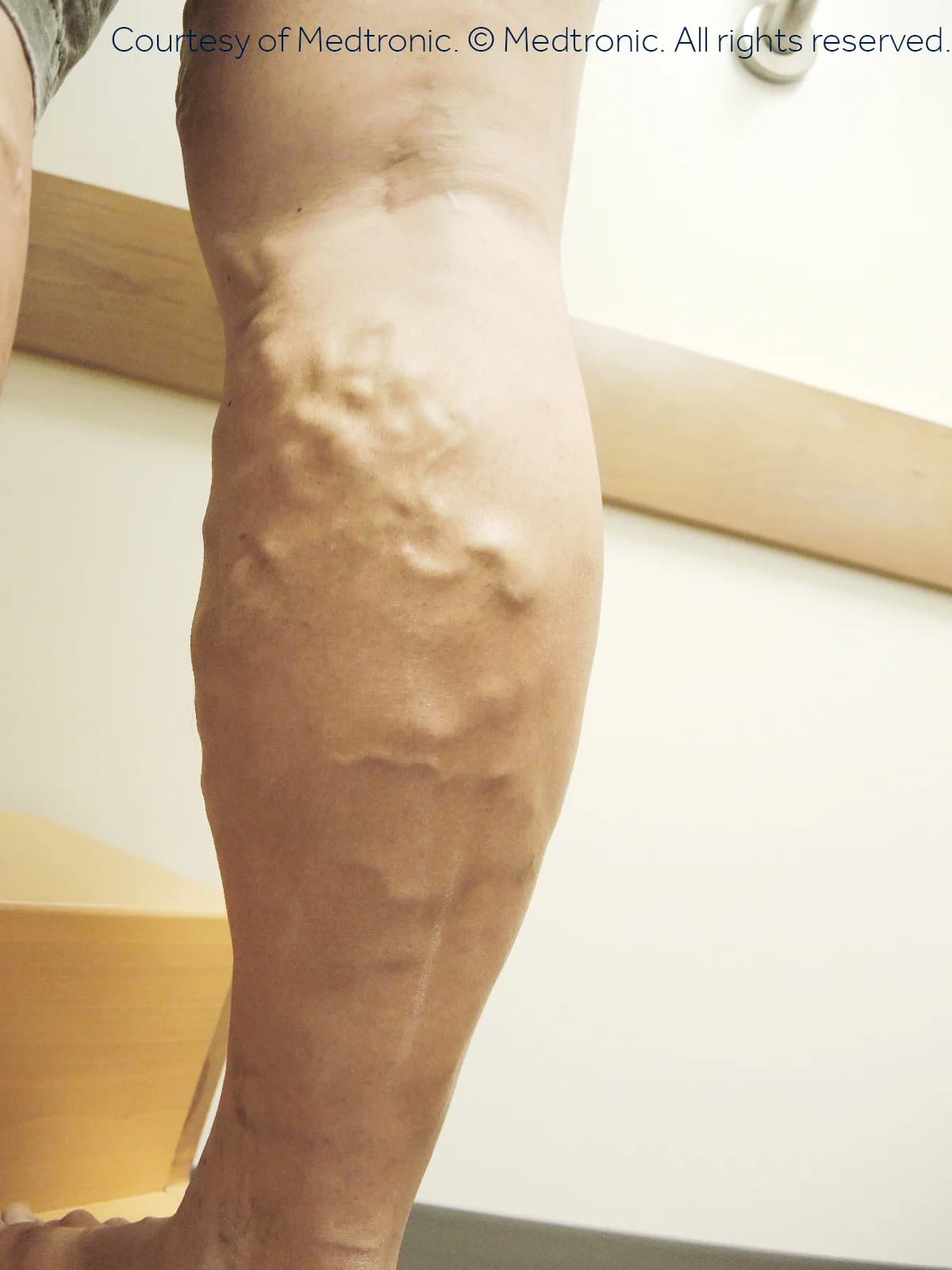 Patient 07, before vein closure procedure.