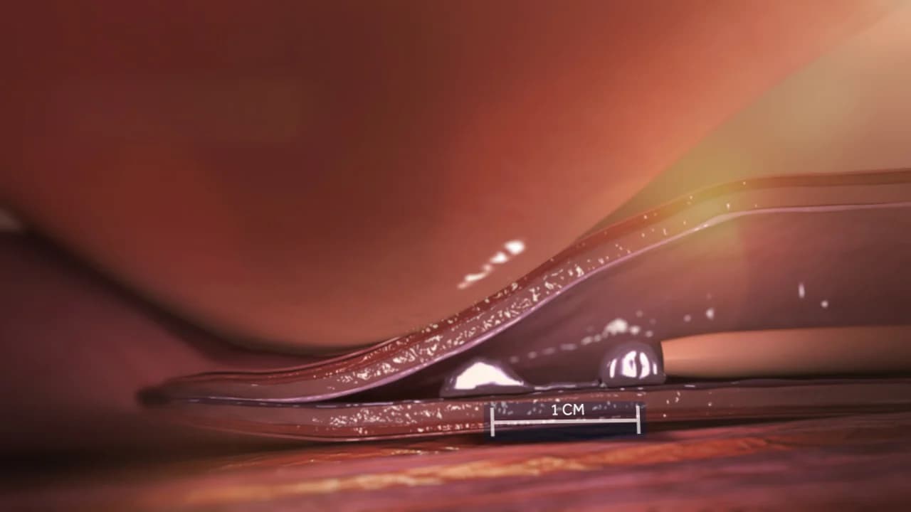 Illustration showing the first and second VenaSeal adhesive aliquot placements along the saphenous vein.