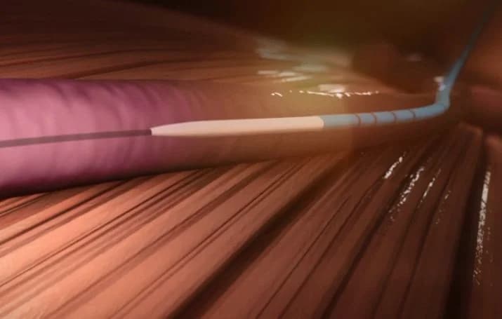 Ultrasound view of the VenaSeal delivery catheter being tracked to the treatment location.