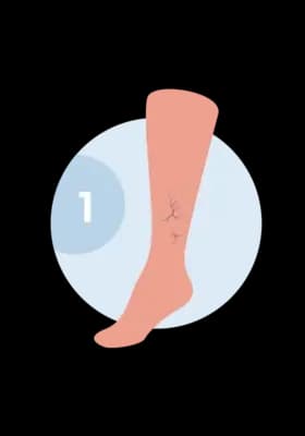 Illustration of a leg with spider veins — tiny thin branching surface capillaries.