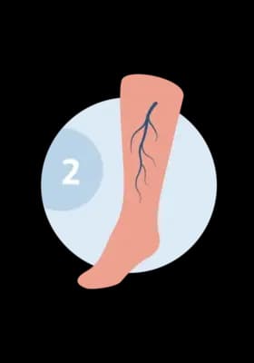 Illustration of a leg with reticular veins — larger blue-green feeder veins beneath the skin.