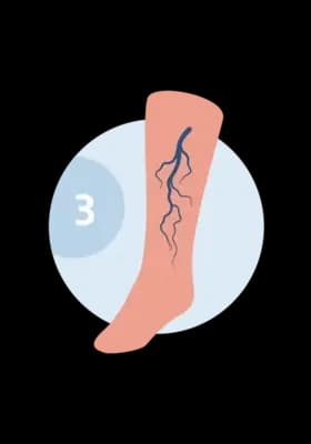 Illustration of a leg with varicose veins — large bulging tortuous veins.