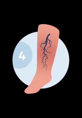 Illustration of a leg with chronic venous insufficiency — a severe vein network and skin discoloration.