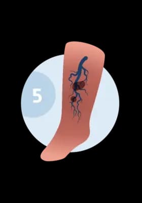 Illustration of a leg with a trophic ulcer — an open, non-healing wound.
