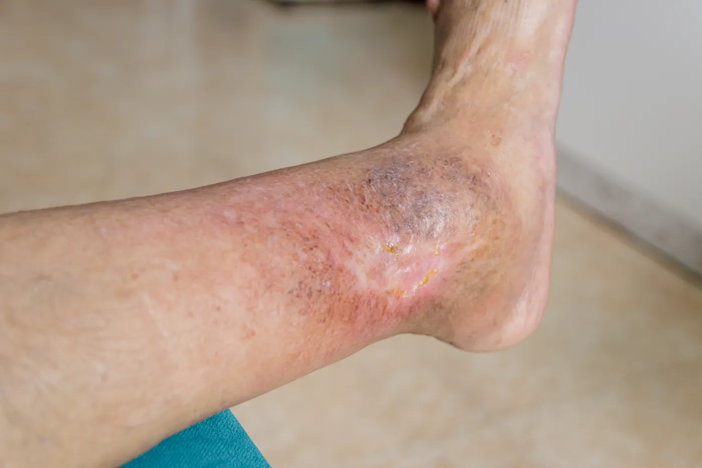Brown, hardened skin changes around the ankle caused by long-standing venous pressure — the stage that precedes a venous ulcer.