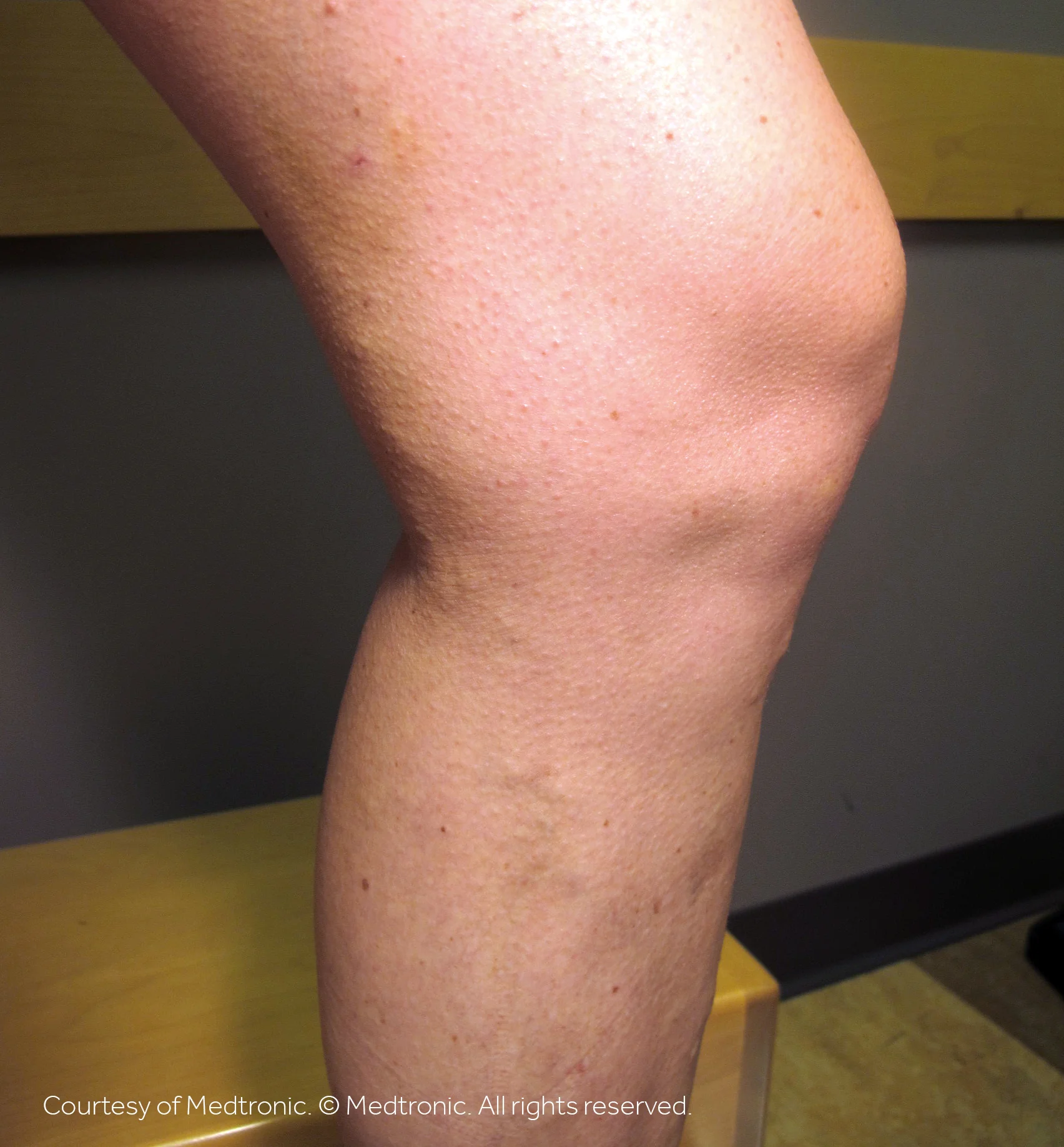 Patient 01, after vein closure procedure.