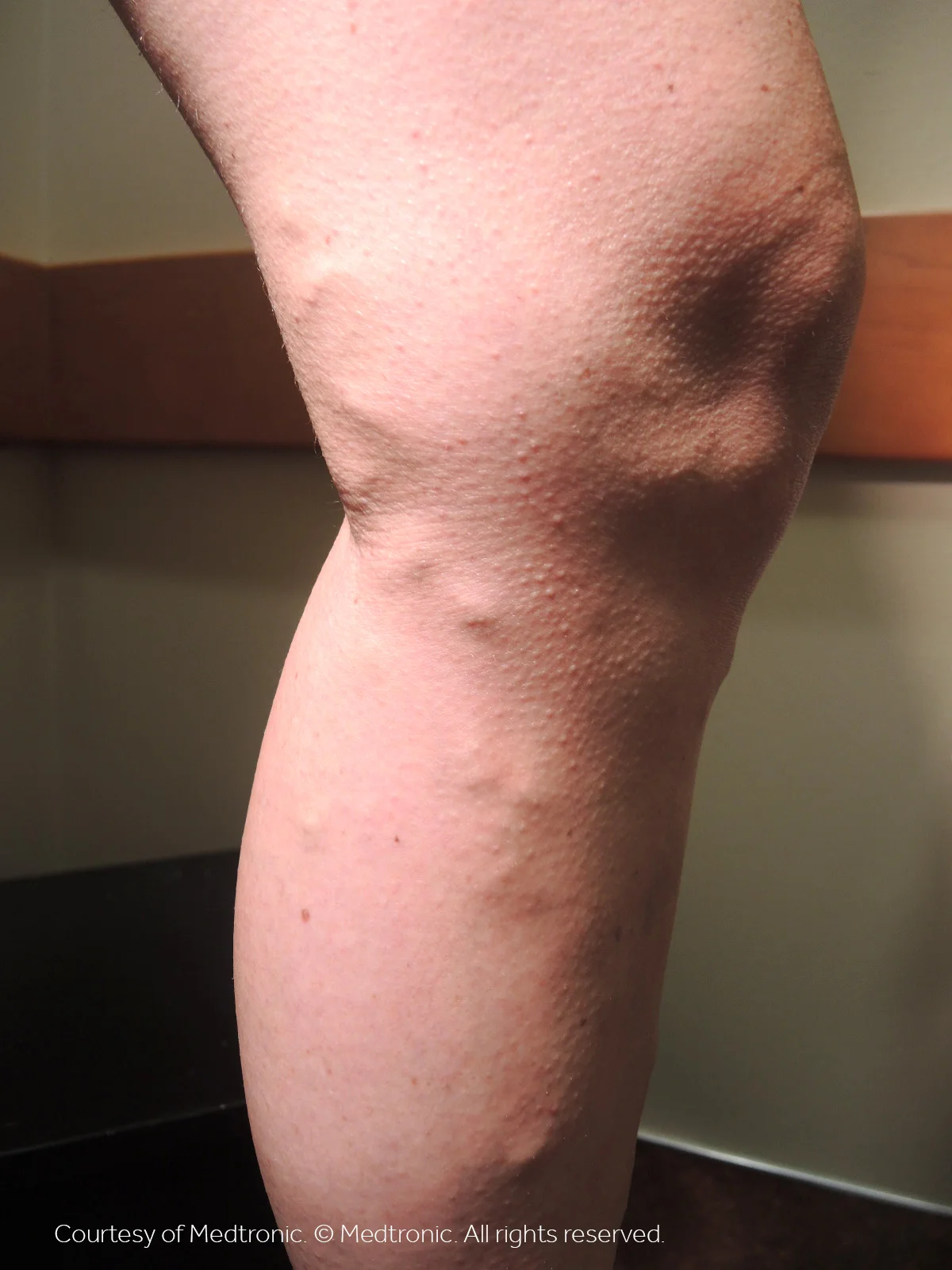 Patient 01, before vein closure procedure.