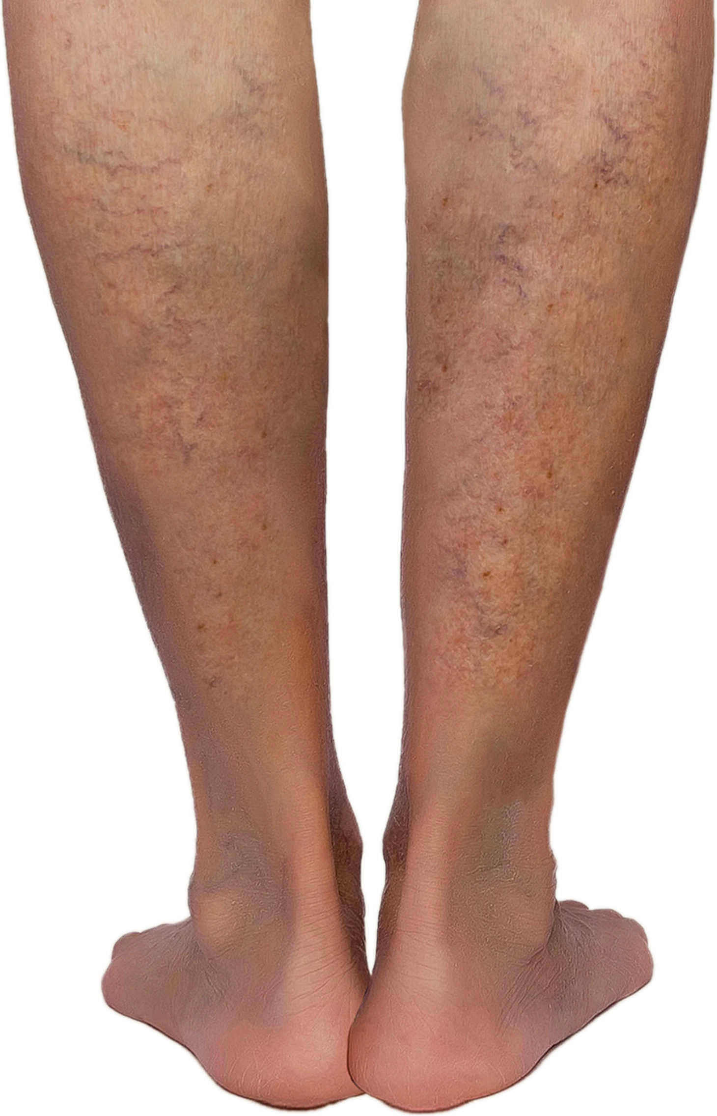 Varicose veins — CEAP C2