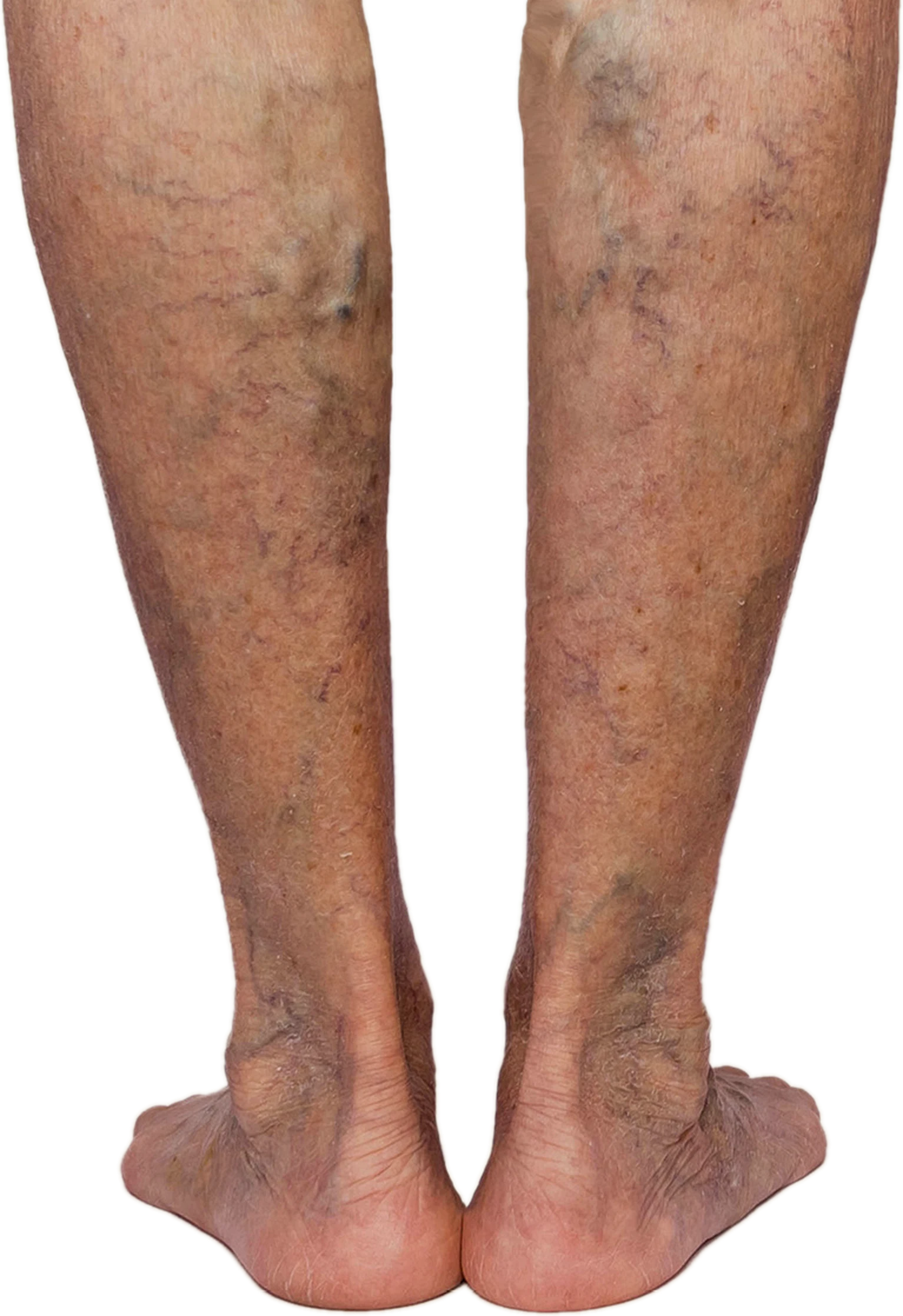 Bulging veins — CEAP C2–C3