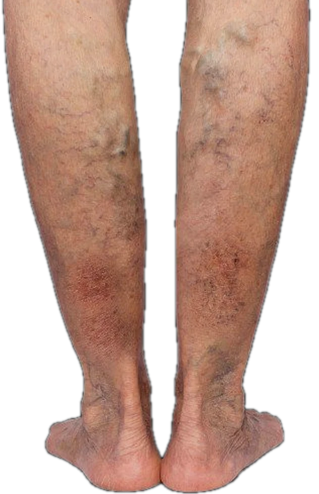 Skin changes — CEAP C4