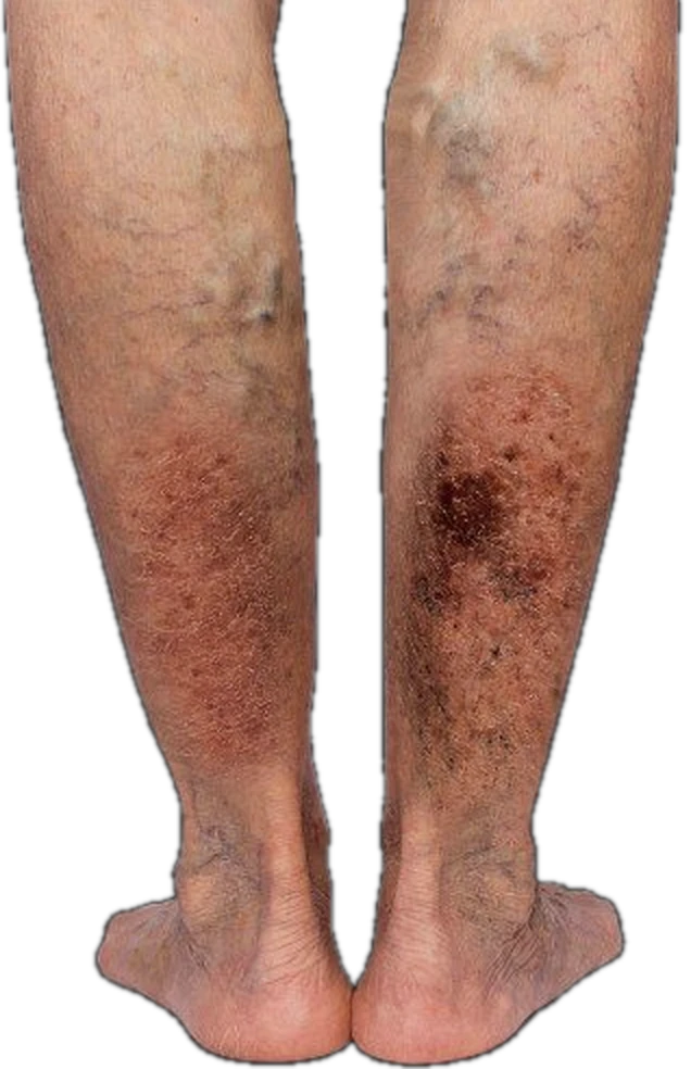 Ulcers & skin breakdown — CEAP C5–C6